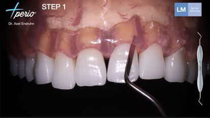 LM-Dental – IETS Protocol for Minimally Invasive Gingival Recession Treatment by Dr. Axel Endruhn