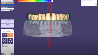 exocad – Quick Guide: Designing a single Arch Denture