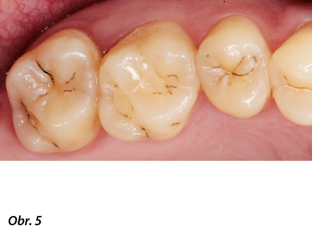 Pohled na okluzi zubů 16, 17.