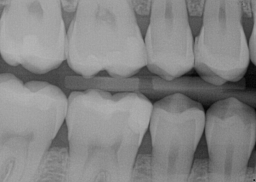 Fig. 20: Bitewing radiograph of the existing composite restorations.