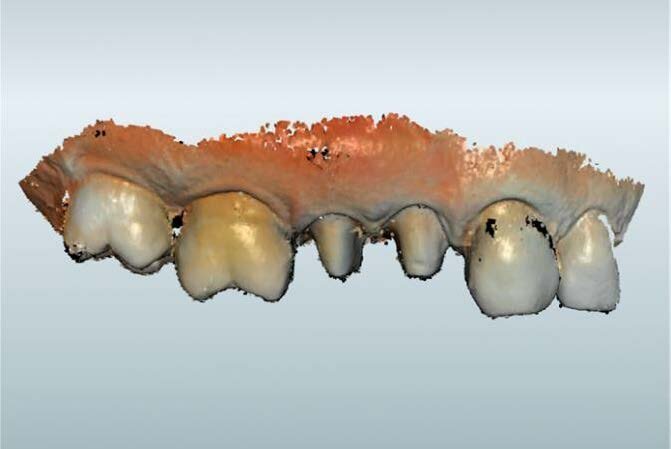 Fig. 3: Upper jaw scan