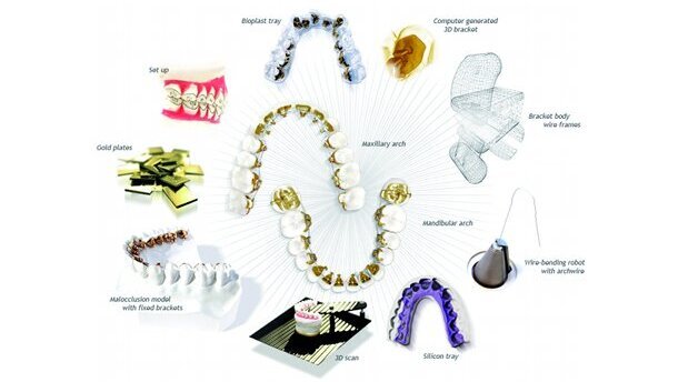 Traitement sans extraction d’un cas de classe II présentant une agénésie de l’incisive centrale mandibulaire au moyen d’un système de CFAO d’orthodontie linguale