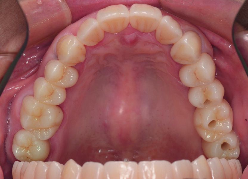 Fig. 10a : Résultat hautement esthétique et fonctionnel. 