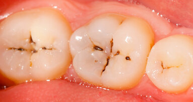 Cáries podem prevenir câncer bucal