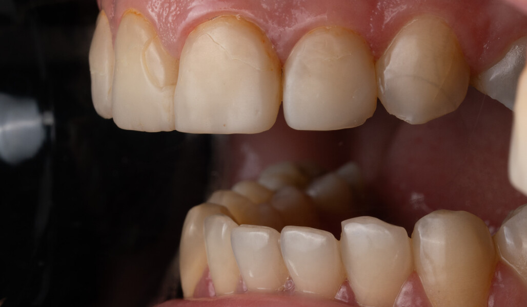 Fig. 1d: Intra-oral lateral view from the left revealing a large debonded and chipped area.