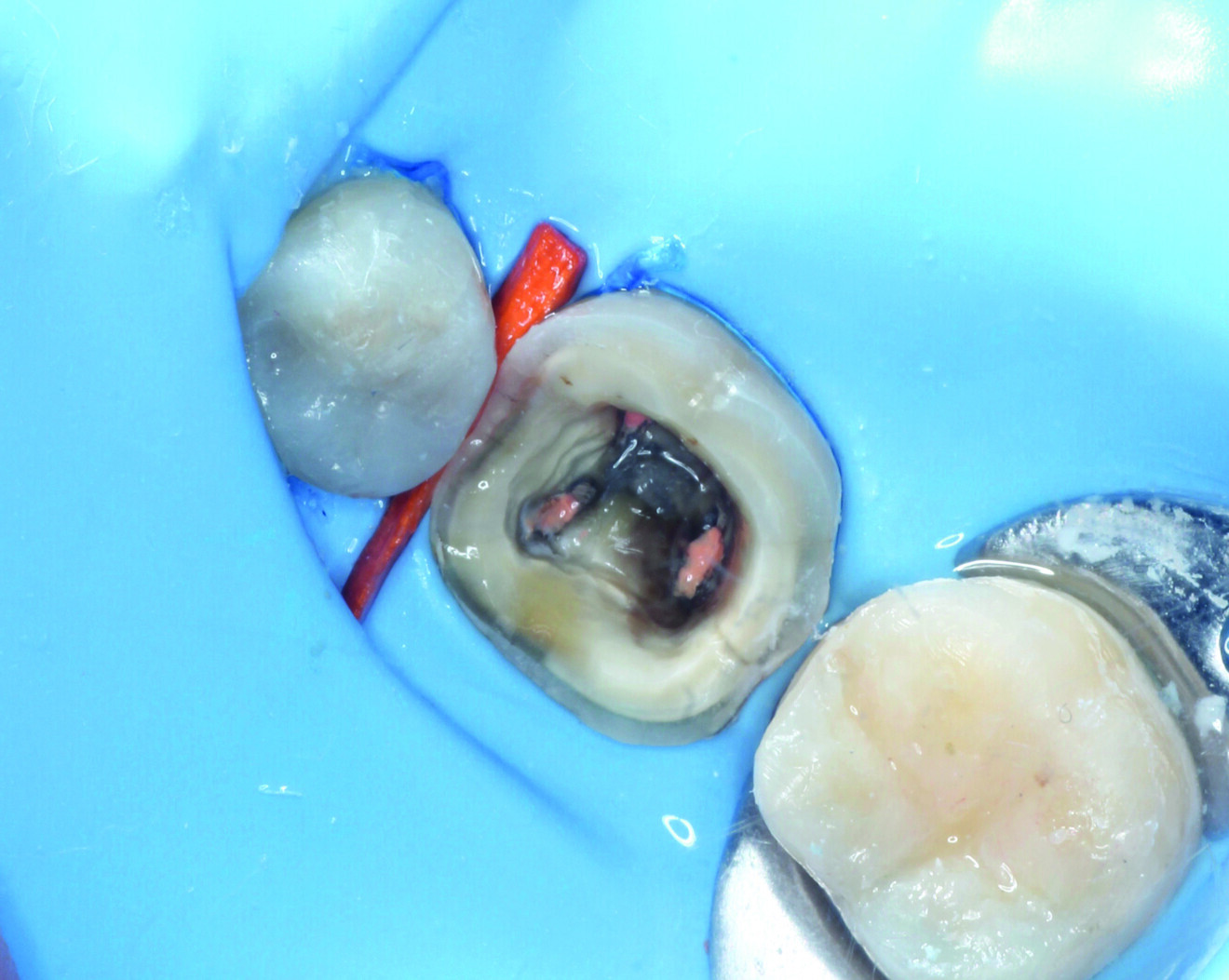 Fig. 5: Completed filling with Grandio.