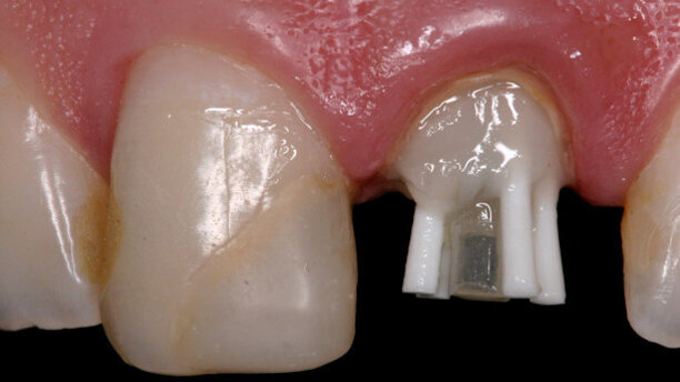 Anatomical pin: A clinical case report
