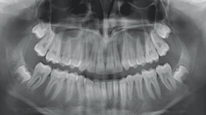Treatment of Class II division 1 malocclusion treatment with mandibular advancement features