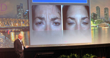 Нови ползи от ботокса