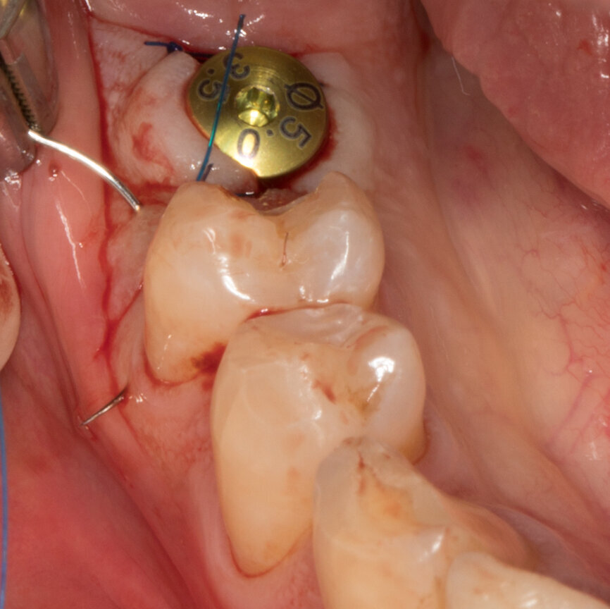 Ryc. 23-25_Dokręcona śruba gojąca na czas projektu i frezowania korony tymczasowej.