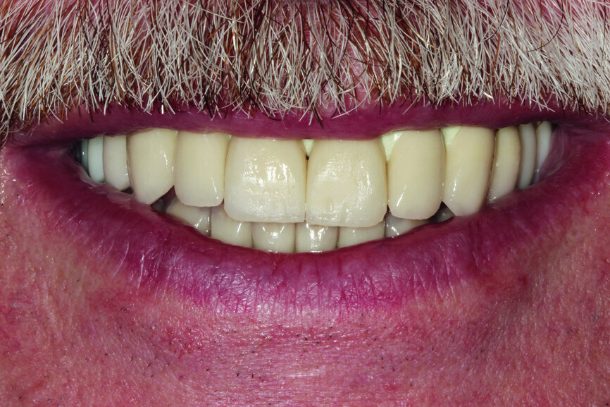 Fig. 15: Test of the construction together with crowns and the mouth slightly open.