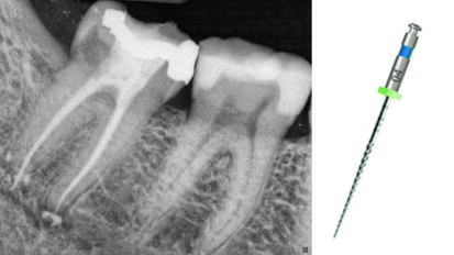 Getting to the 00.00 point