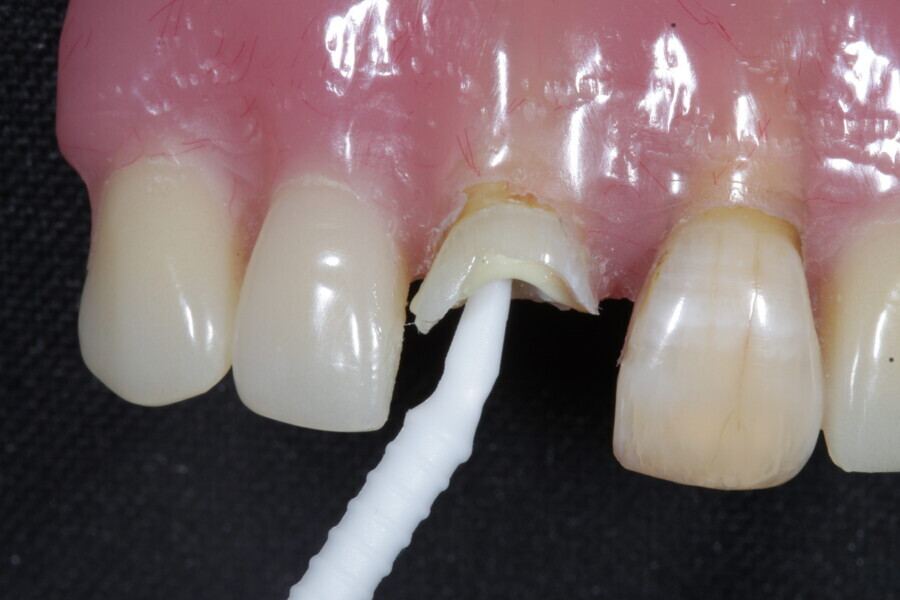 Fig. 5: Bonding agent is applied with a micro-brush.