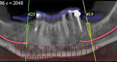 Virtual dental implant planning: the next step