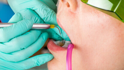 BIOLASE and DCA plan to expand laser adoption in dental offices BIOLASE and DCA plan to expand laser adoption in dental offices