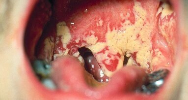 Cientistas descobrem micro-organismos que previnem infecção bucal