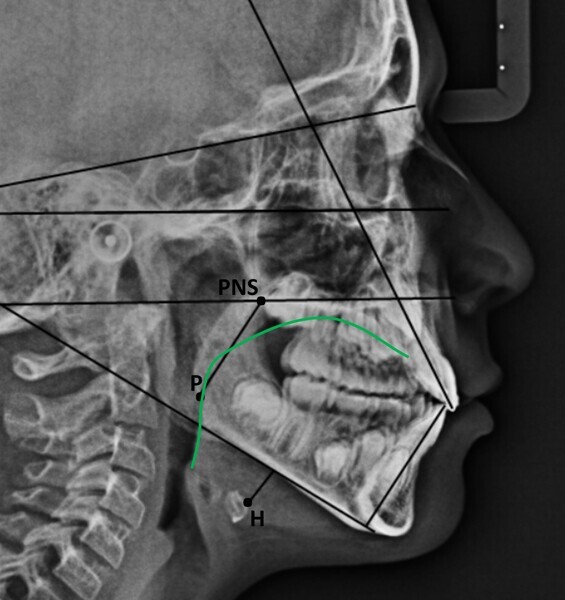 Fig. 16b: Comparison of the cephalometric radiograph, functional tracing and lingual position at the (a) start (red line) and (b) end of treatment (green line). PNS = posterior nasal spine; H = hyoid bone; P = tip of the soft palate.
