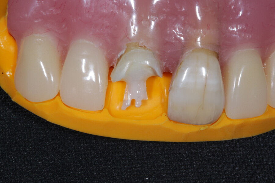Fig. 13: The fit of the pre-prepared silicone template is checked.