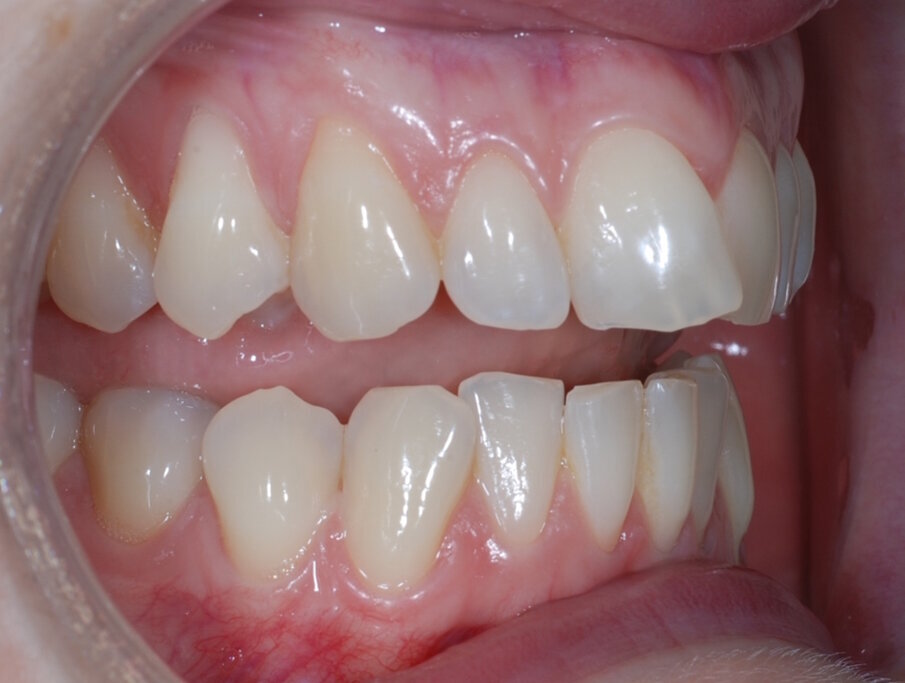Fig. 4: Pre treatment retracted right lateral open bite