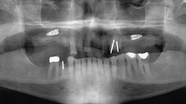 Prévention des échecs en implantologie orale