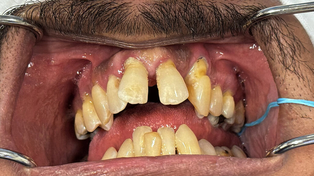 AI-facilitated bone segmentation for the fabrication of bone-borne surgical guides