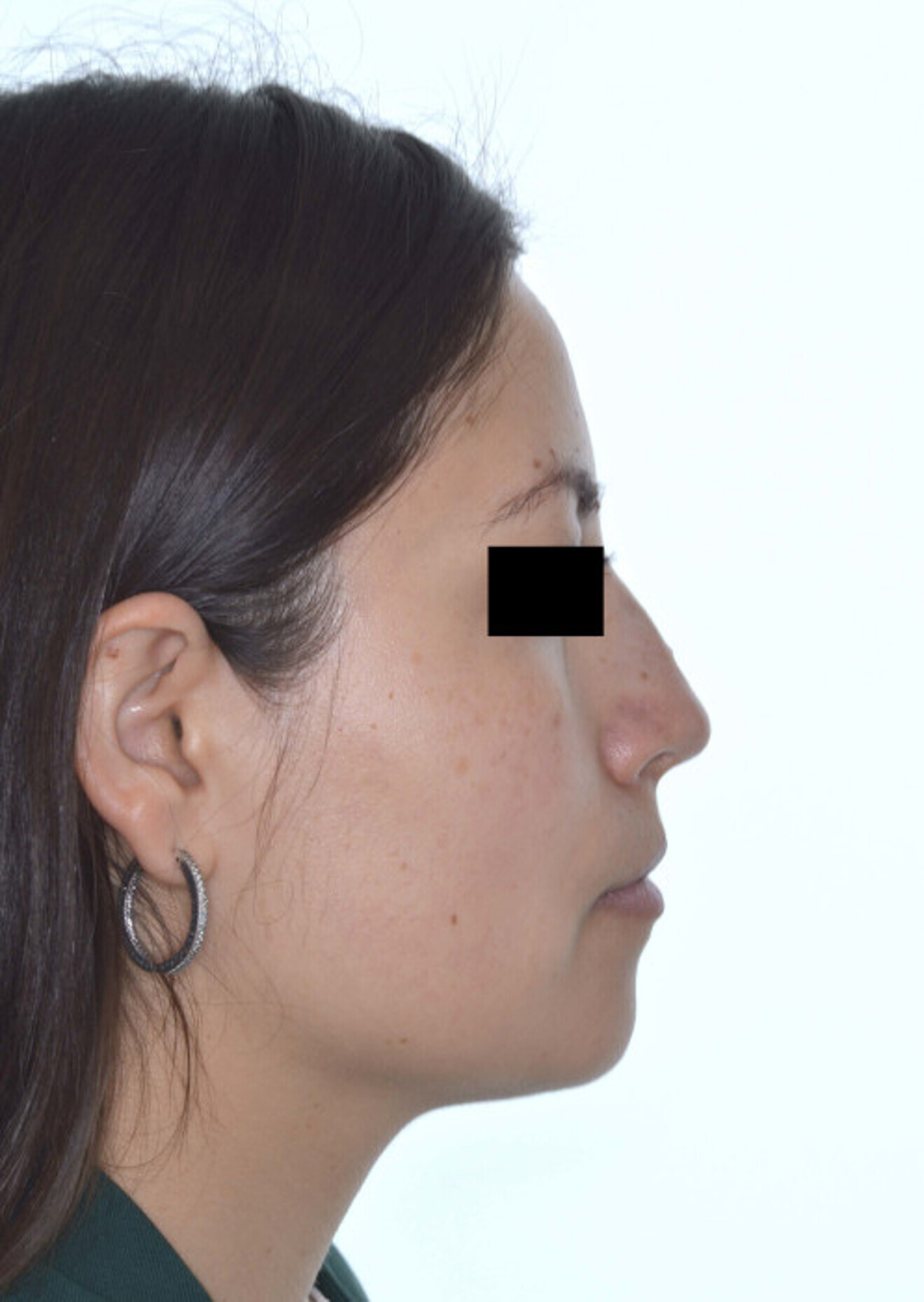 Fig. 11b: ... and after.