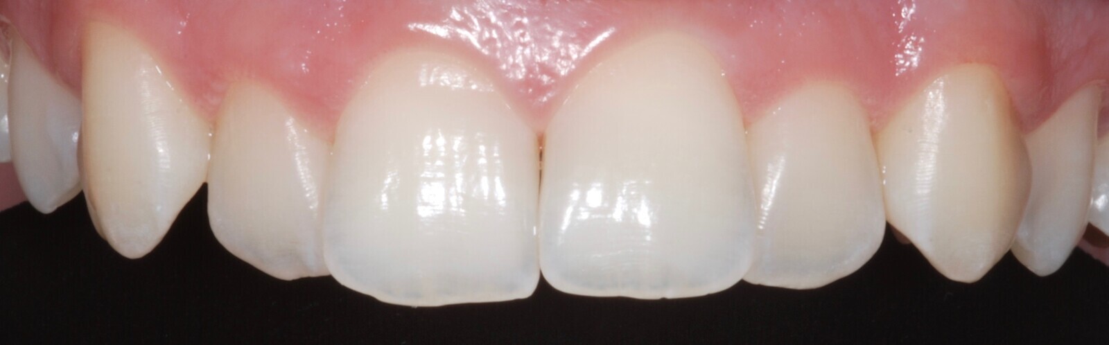 Fig. 35: Close-up intra-oral maxillary frontal view before treatment.