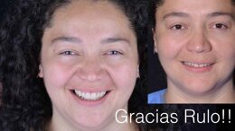 Dr. Mahn: Ceramic Contact Lenses: The Minimal Invasive Way Of Doing Veneers. Hands-On Course