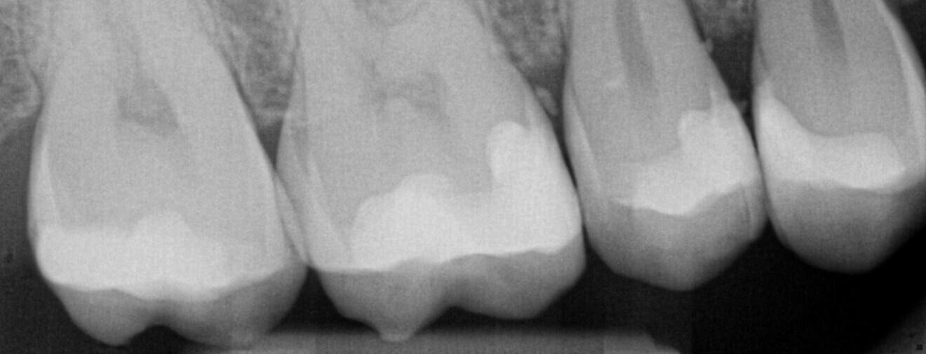 Fig. 27: Periapical radiograph of the restorations after luting.