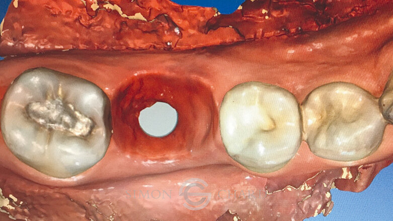 Výroba suprakonstrukce na implantát pomocí CERECu