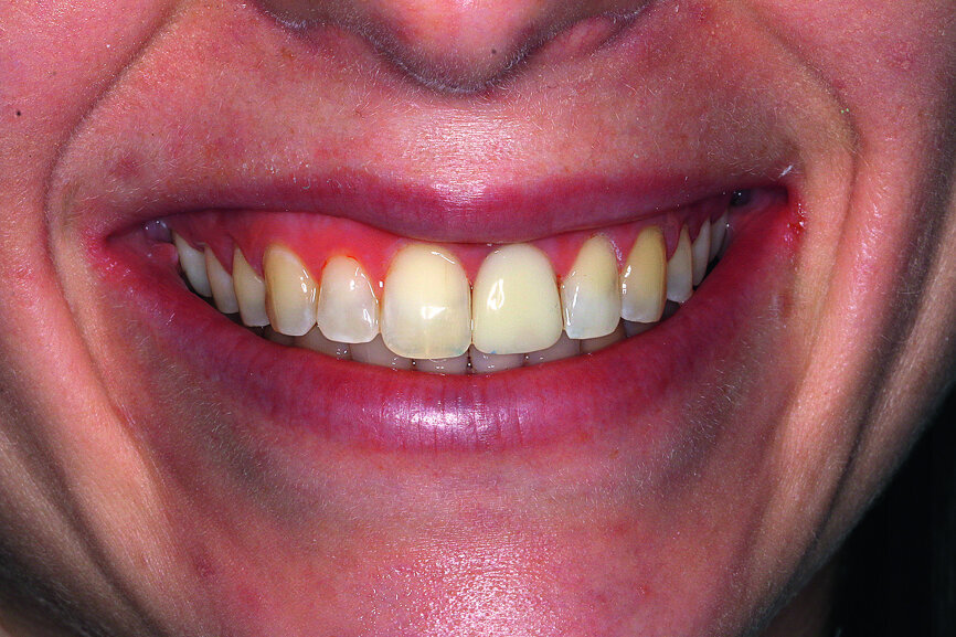 Fig. 14: Situation immediately after insertion of the crown.