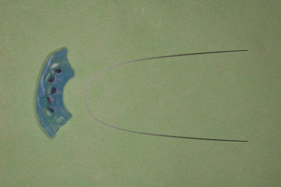 Fig. 30: Indirect bonding tray and 0.014 in. nickel–titanium wire.