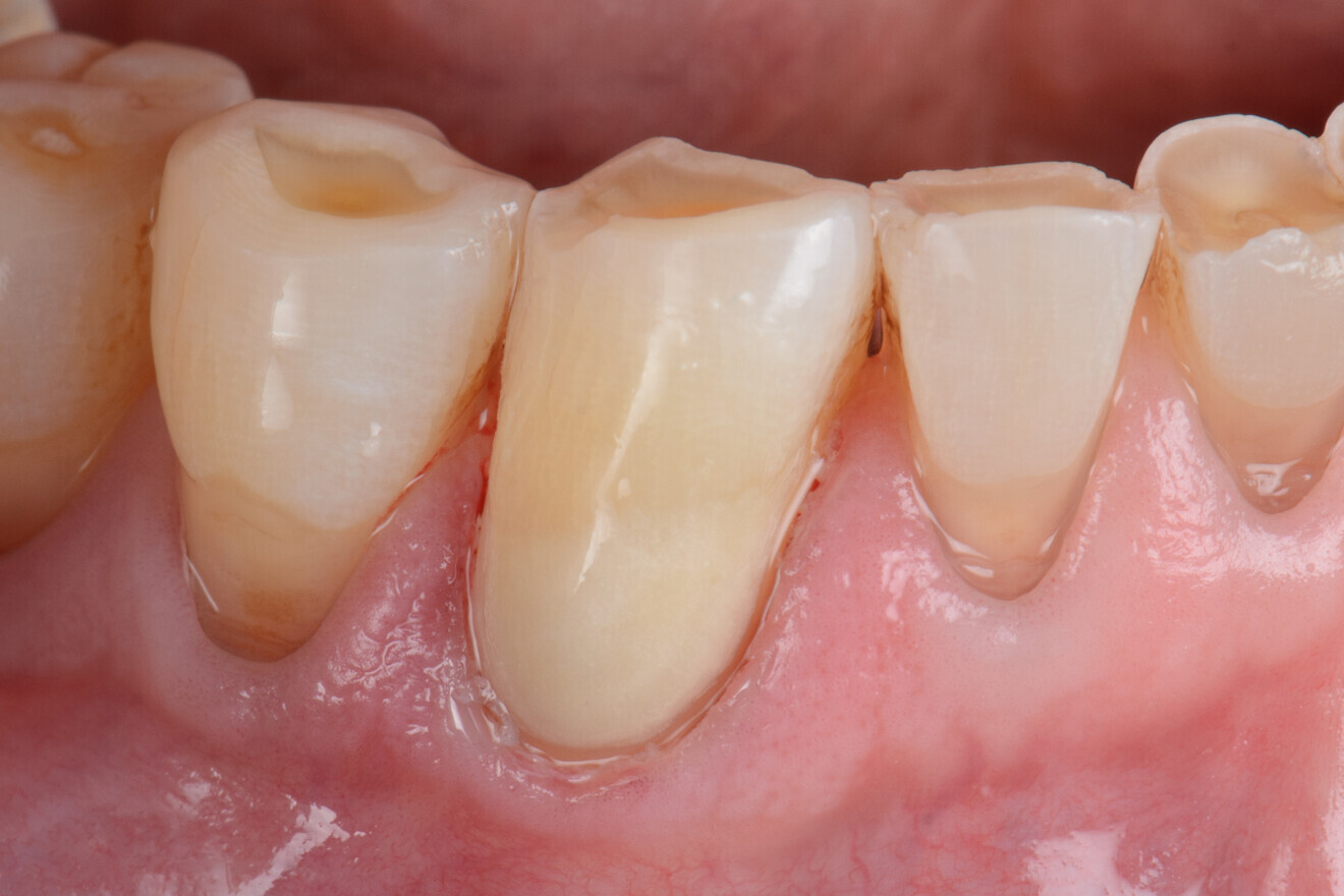 Fig. 3c : restauration après la finition (avec l’aimable autorisation du Dr Javia Tapia Guadix, Espagne). 