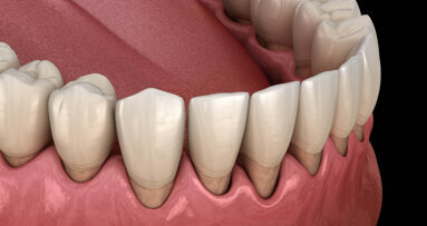 Biomimetička remineralizacija – prevladavanje preosjetljivosti dentina kod parodontalne bolesti