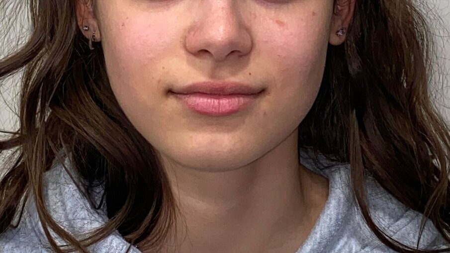 Fig. 14_Viso post-trattamento.