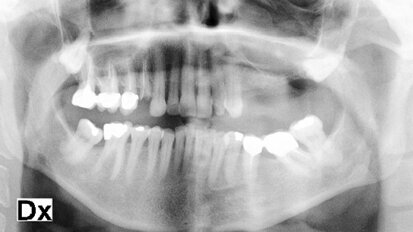 L’utilizzo dei derivati piastrinici nel grande rialzo di seno mascellare