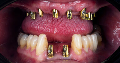 Impact of China’s volume-based procurement on the Asia Pacific dental implant market