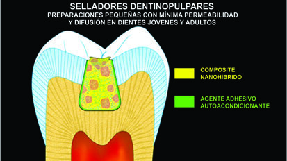 Metodología del sellado dentinopulpar (Segunda parte)