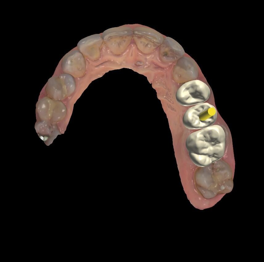 Fig. 11 - Quando il file viene spedito al laboratorio odontotecnico sarà in grado di essere processato per la finalizzazione del progetto ipotizzato dal clinico. Si può vedere l’immagine delle corone sui denti naturali e dell’impianto col perno passante in giallo per identificare la possibilità di poter avvitare la corona che si andrà a realizzare.