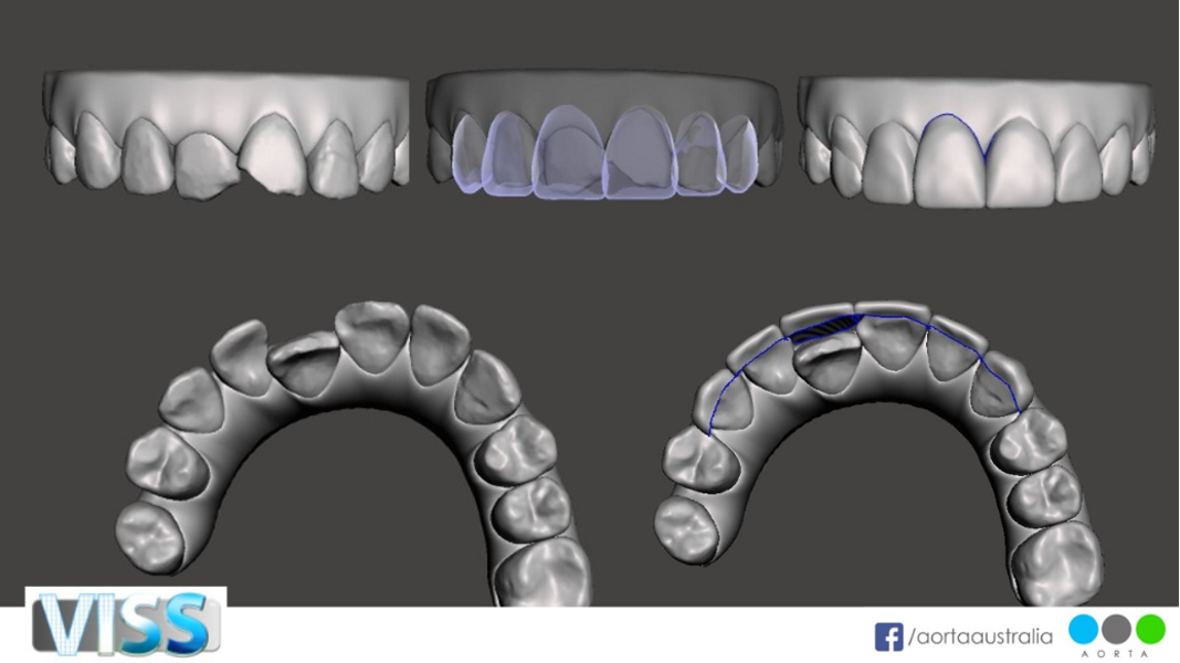 Figs. 34a–e: Simulated VISS images showing the situation pre-treatment (a & d), post-treatment (c & e) and after restorative treatment (purple).