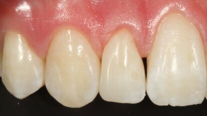 Eén composiet, één kleur voor alles?