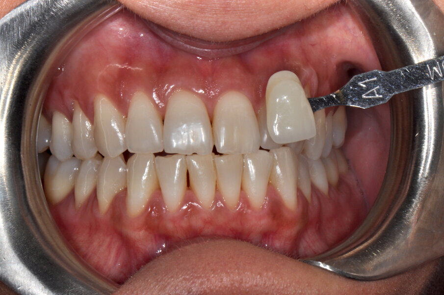 Fig. 5 - Stabilizzazione del colore ad una settimana.