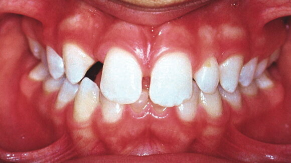 Adolescent Hypodontia: Management