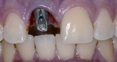 Die rot-weiße Ästhetik im Frontzahnbereich