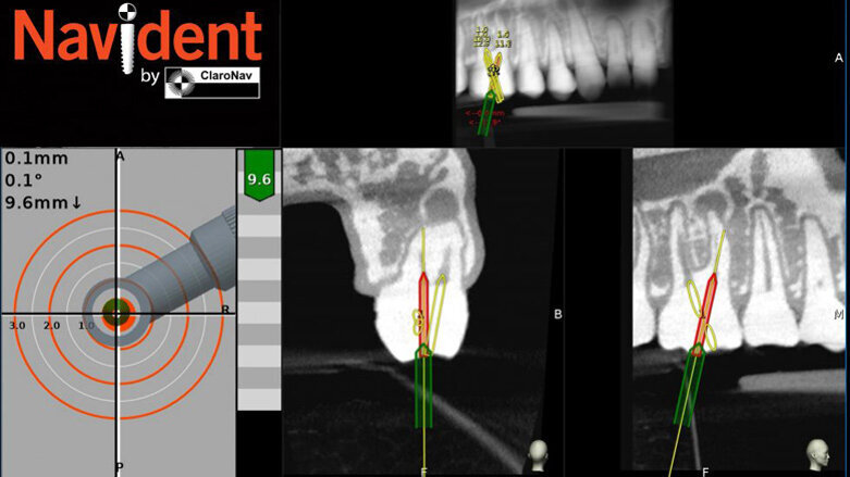 Navident obtains regulatory approvals for guiding root canal treatment