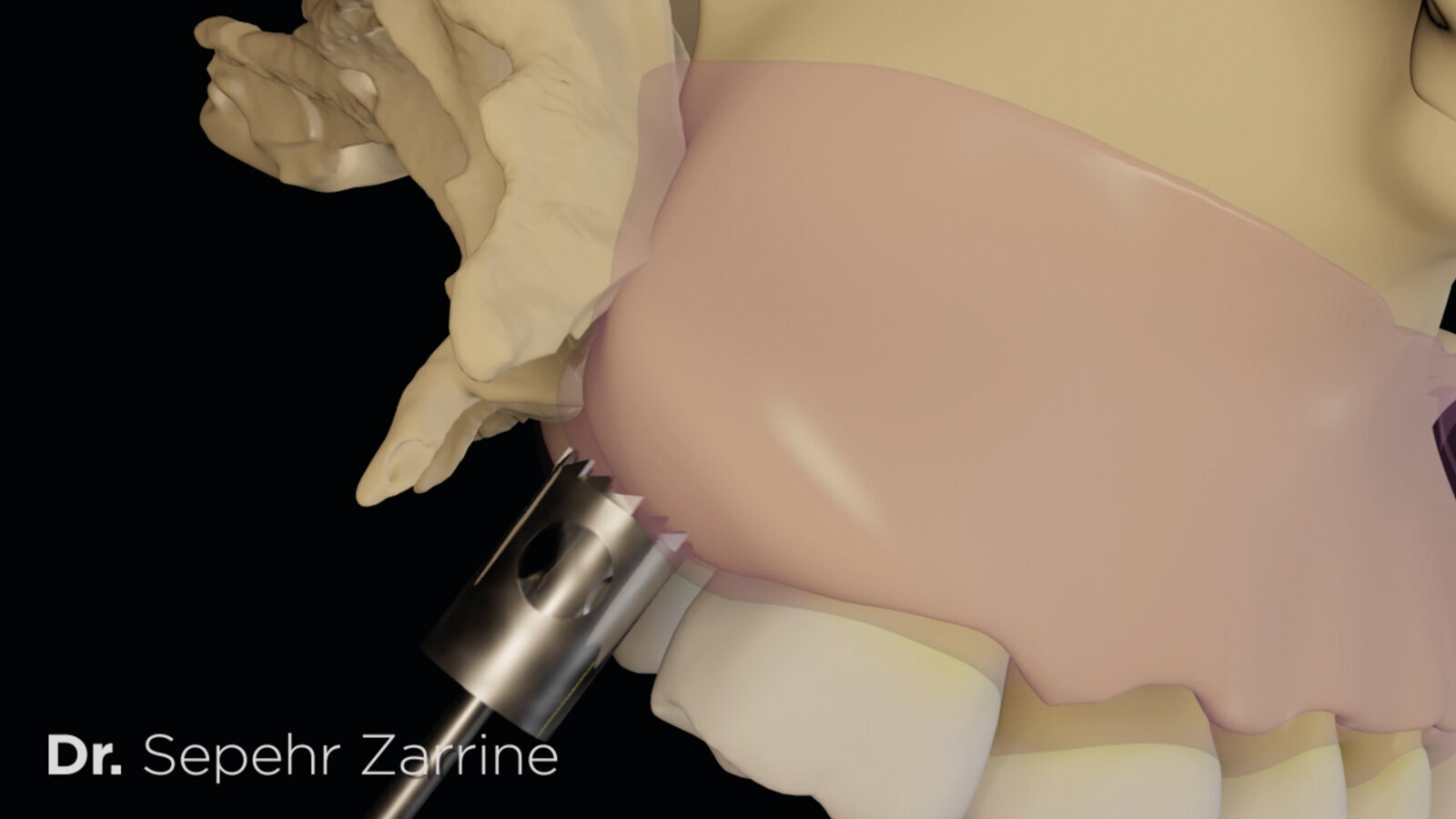 Carotte impactée transversalement.