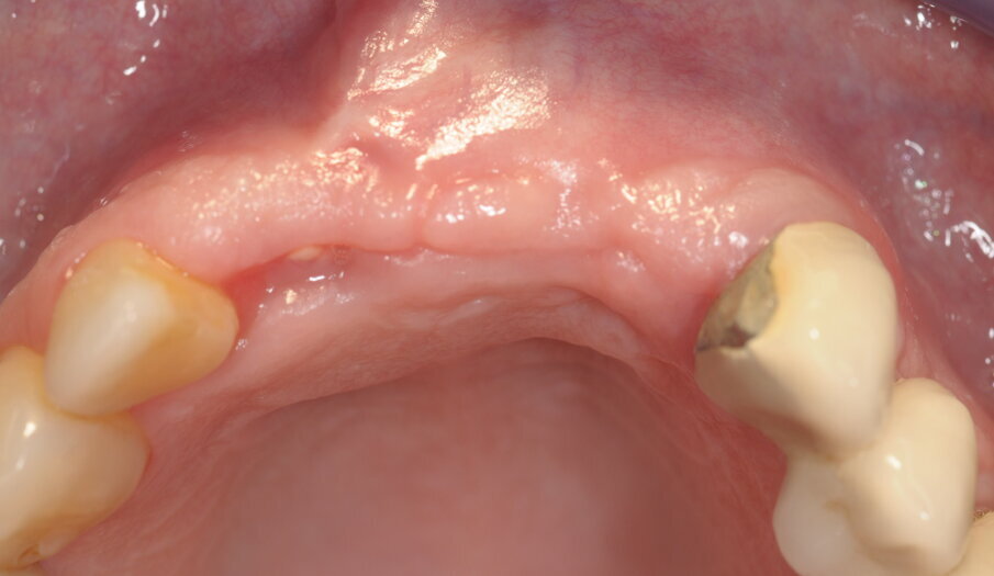 Fig. 15 - Valutazione sito rigenerato in visione occlusale.
