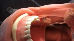 Prof. Paul Tipton: Root Filled Teeth – Practical Restoration Concepts. Hands-on course
