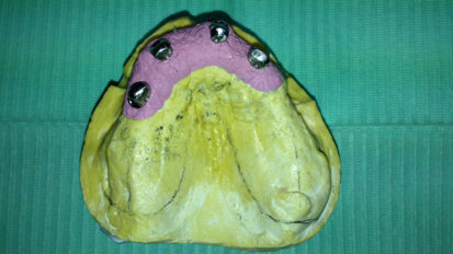 Edentulia risolta con attacco monolaterale