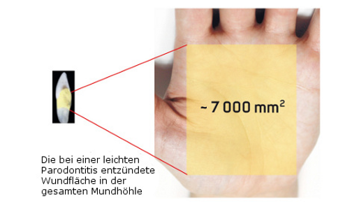 EMS – AIRFLOW Kills Biofilm